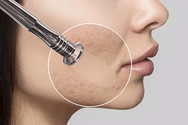 Microdermabrasion